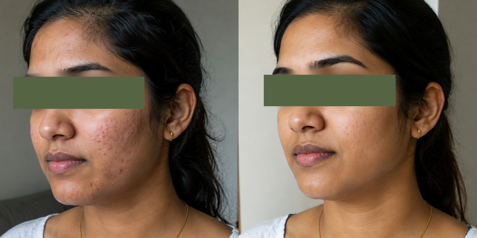 acne treatments